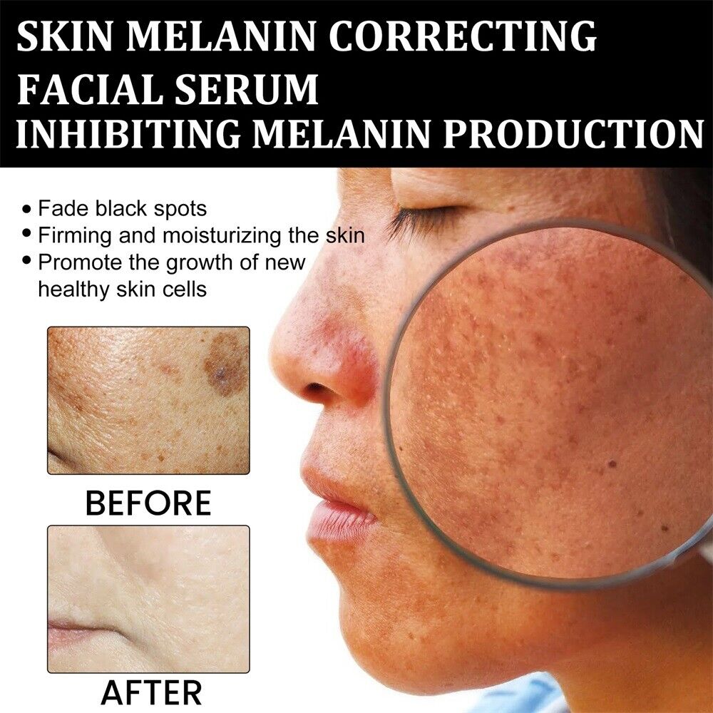 🔥Fast Dark Spot Remover-AQA™ Melanin Correcting Brightening Serum