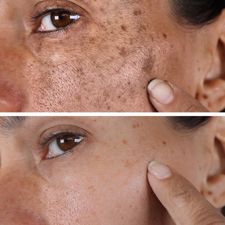 🔥Fast Dark Spot Remover-AQA™ Melanin Correcting Brightening Serum