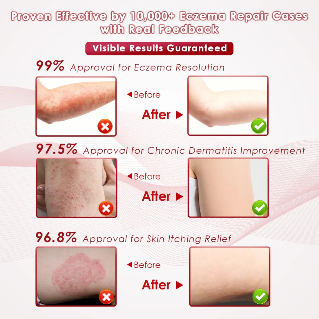 Ealthsn® Herbal Miracle Cream for Jock Itch (Tinea Cruris)