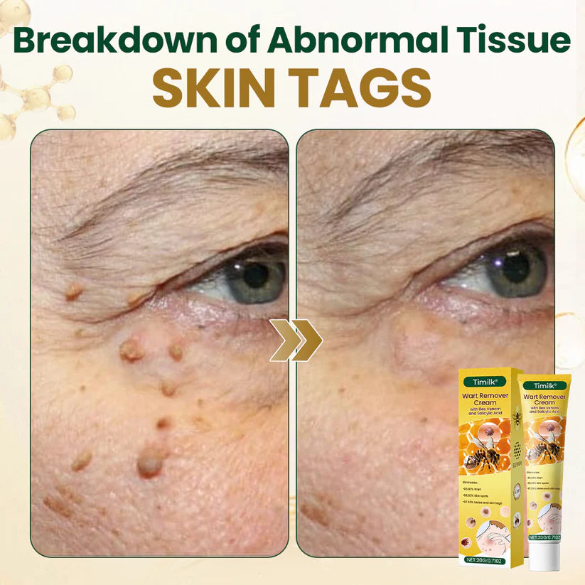 Timilk® Wart Remover Cream with Bee Venom and Salicylic Acid – Skin Tag Removal & Skin Repair Formula for Face and Body