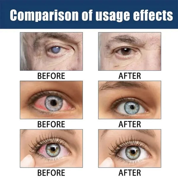 🔥LAST DAY PROMOTION🔥 - Presbyopia Recovery Treatment Drops